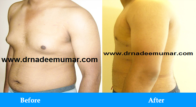 Liposuction Surgeon in Islamabad, Pakistan - Dr. Nadeem Umar
