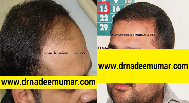 fue-hair-transpalnt-before-after1