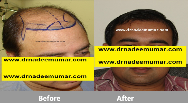 fue-hair-transpalnt-before-after3