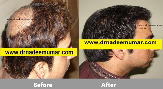 fue-hair-transpalnt-before-after4