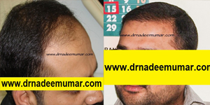 fue-hair-transpalnt1